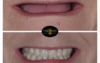 teeth reconstruction before and after with hive logo in the middle