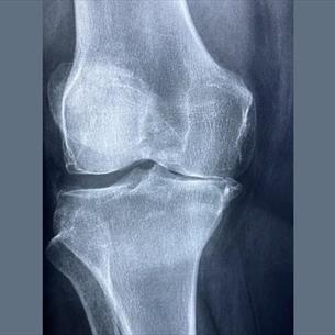 x-ray photograph of a knee joint