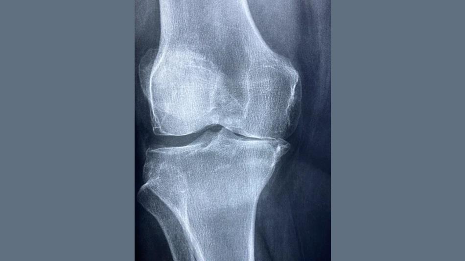 x-ray photograph of a knee joint