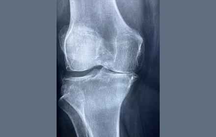 x-ray photograph of a knee joint